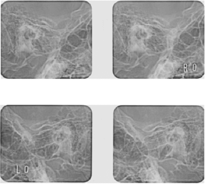 顎関節規格写真や顎関節MRI